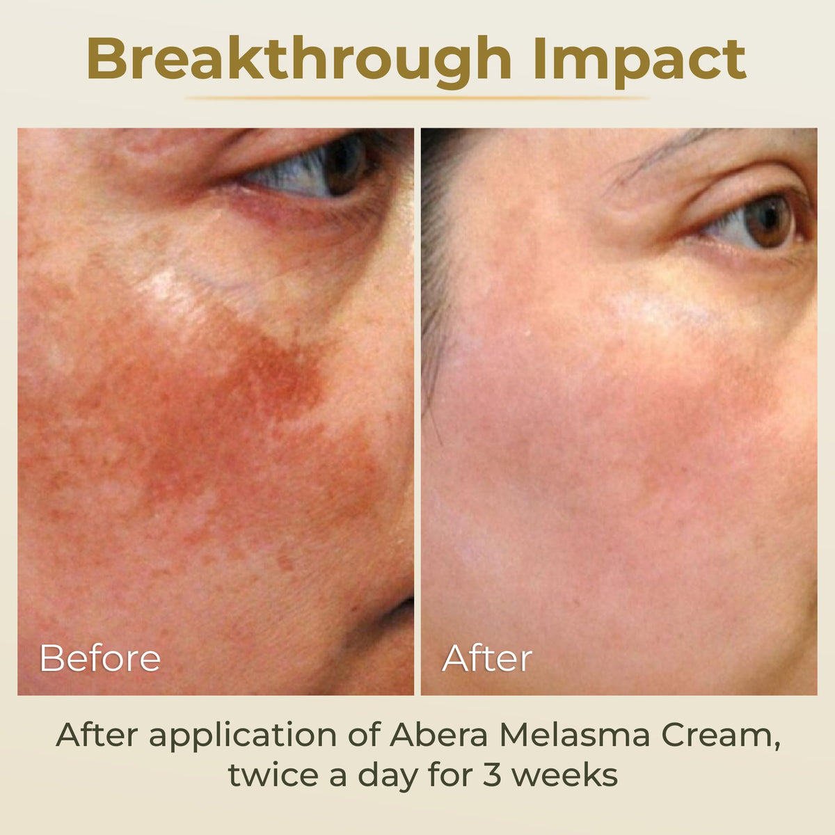 ABERA Melasma Cream applied to neck and chest for even skin tone