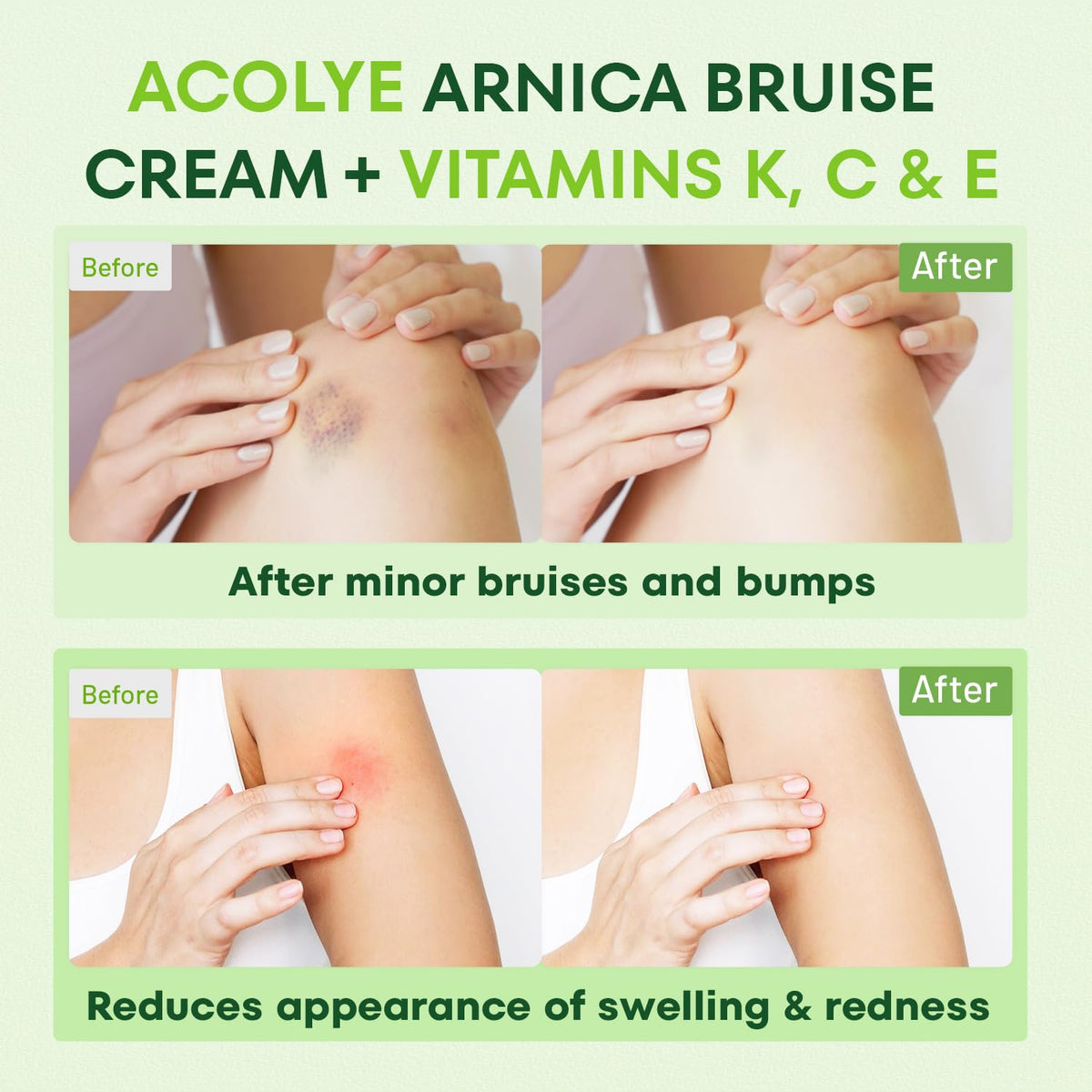 Acolye Arnica Cream on legs supports a balanced, even appearance after minor injuries.