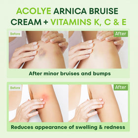 Acolye Arnica Cream on legs supports a balanced, even appearance after minor injuries.