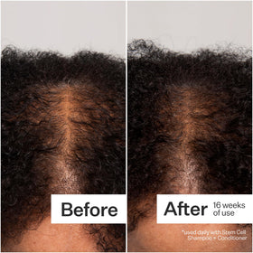 ACT+ ACRE clinical study reference showing density improvement
