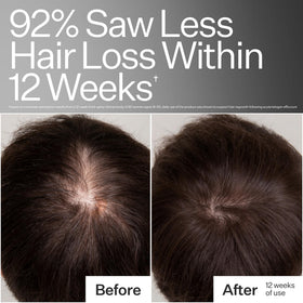ACT+ ACRE Stem Cell Scalp Serum application on hairline to promote scalp health.