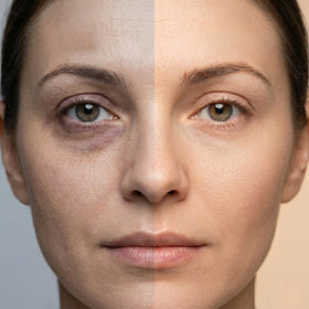 Anacis Vitamin K1 Oxiderm Cream supports post-procedure care with targeted formula.