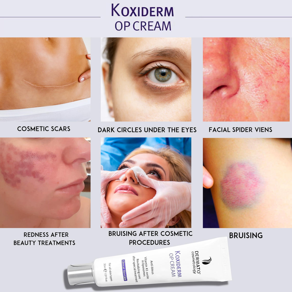 Anacis Vitamin K1 Oxiderm Cream reduces under-eye puffiness for smoother skin.