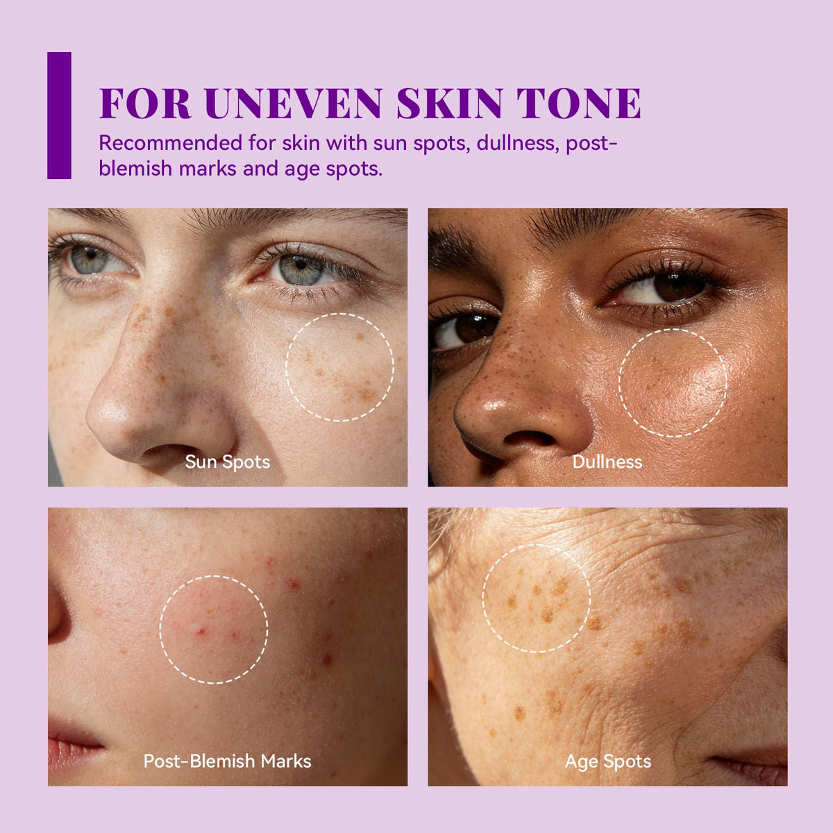 Applying ANAI RUI Tranexamic Cream on the cheek for an even complexion.