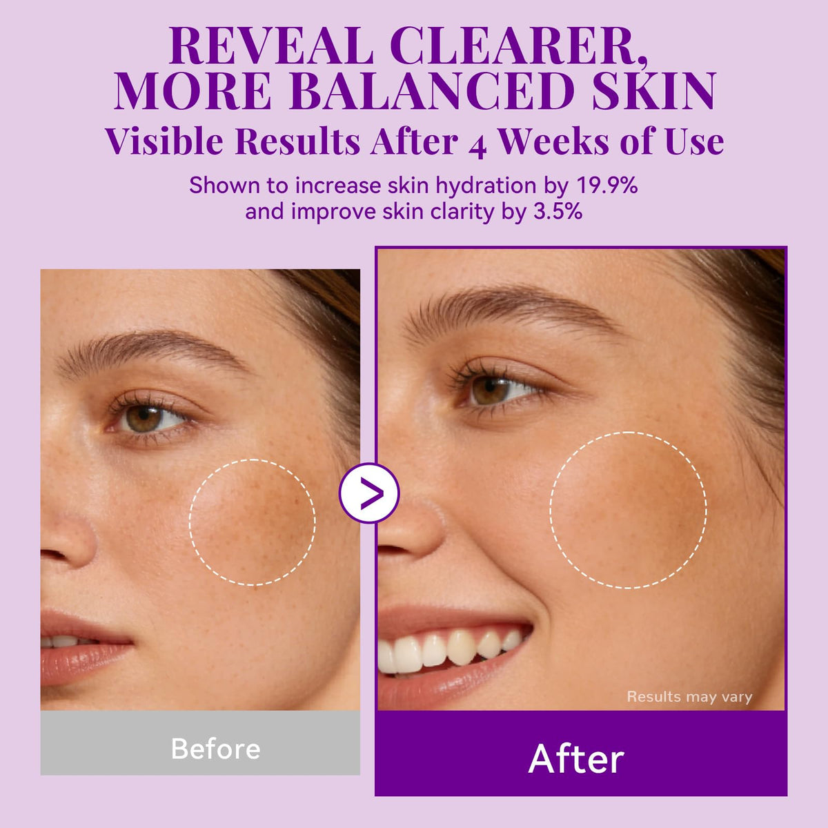 Active ingredients Arbutin and TXA in ANAI RUI Cream target uneven spots.