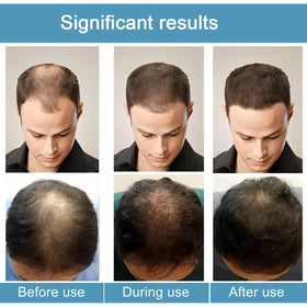 ANEFOSE Hair Regrowth System scalp massage; promotes even distribution and soothing routine.