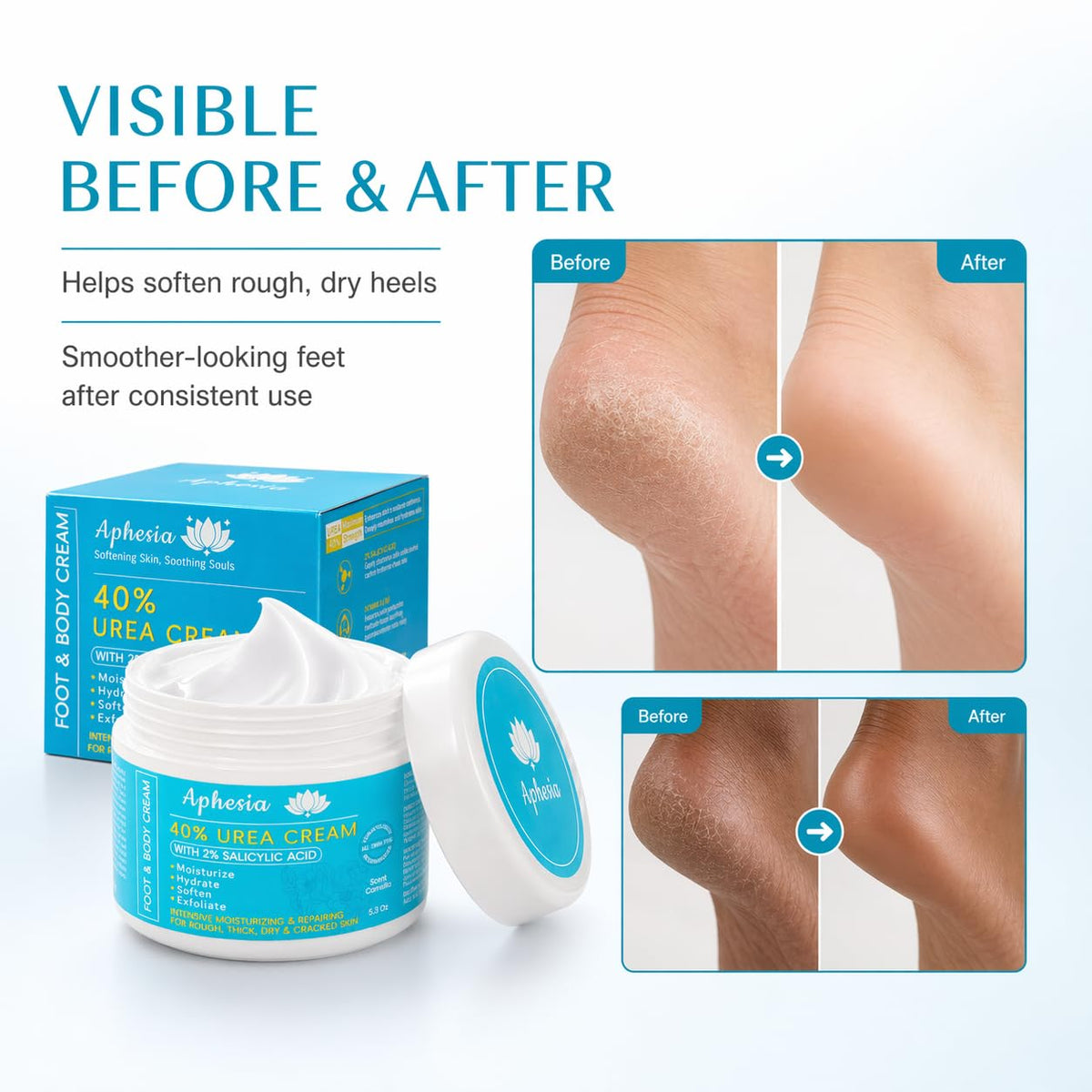 Aphesia Urea Cream 40% fast-absorbing moisture without greasiness.