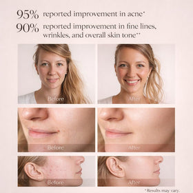 Aphrona Halo Face Mask neck area and chin fit for comfort.