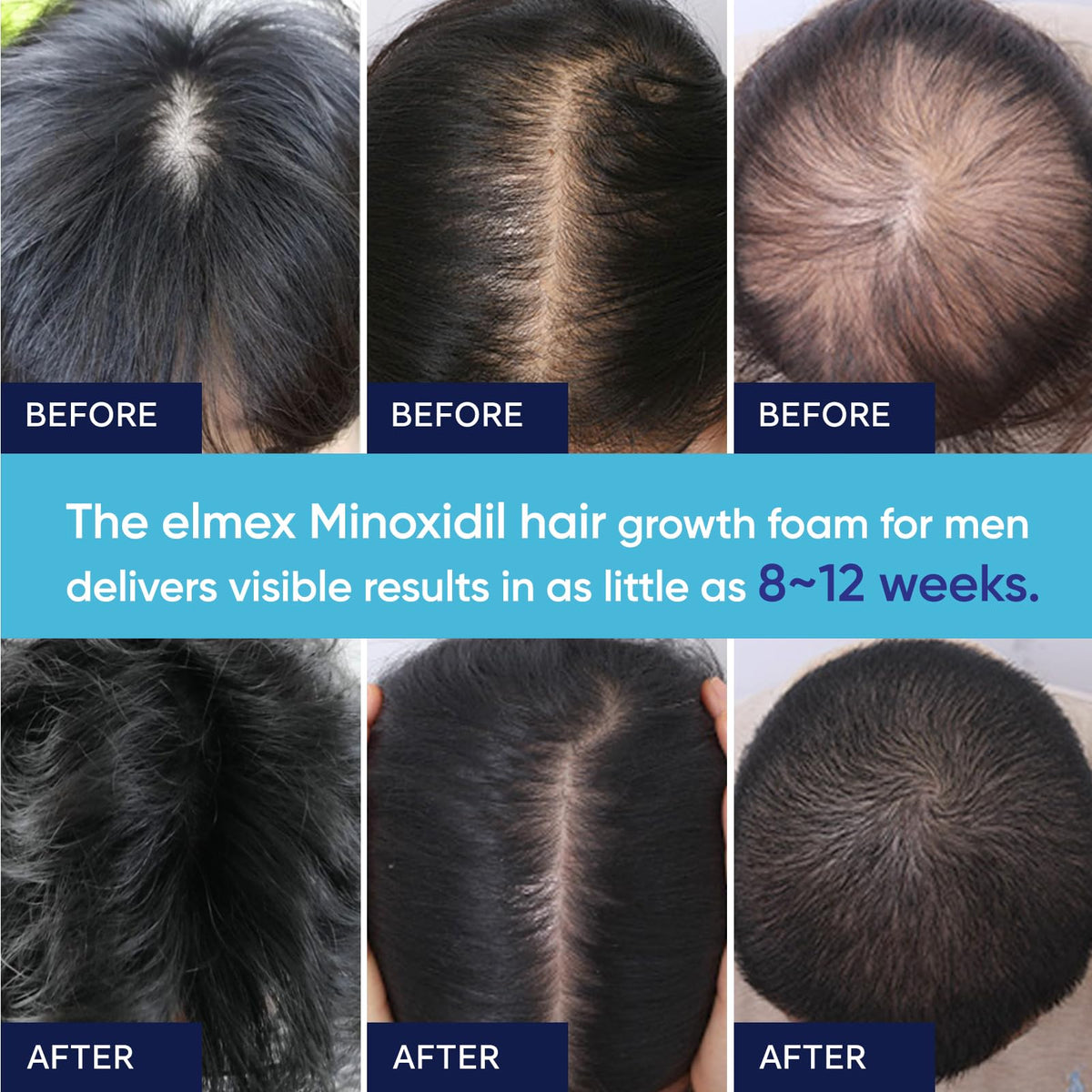 Artimore 5% Minoxidil Foam hair growth illustration visualizes potential thinning hair support.