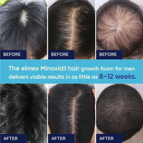 Artimore 5% Minoxidil Foam hair growth illustration visualizes potential thinning hair support.