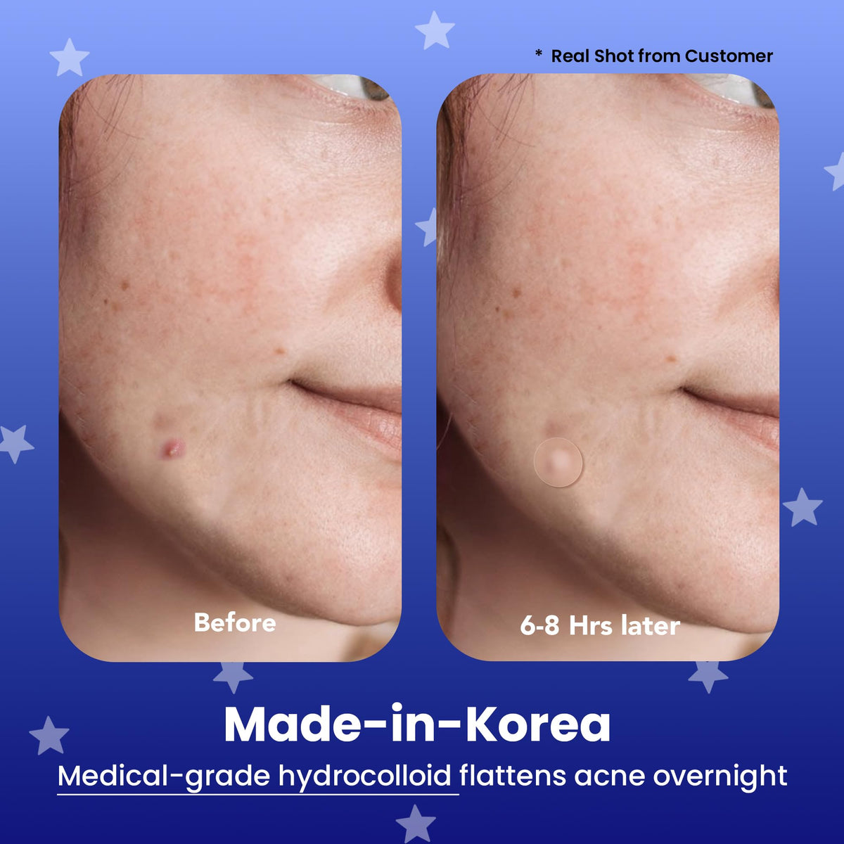 AVARELLE Good Night acne patches pack ready for overnight use.