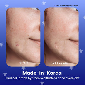 AVARELLE Good Night acne patches pack ready for overnight use.