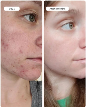 Glow after use with Averr Aglow Clear Skin Elixir on skin.