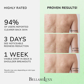BellamiLuxx bacne spray mist on back demonstrates quick, mess-free coverage.