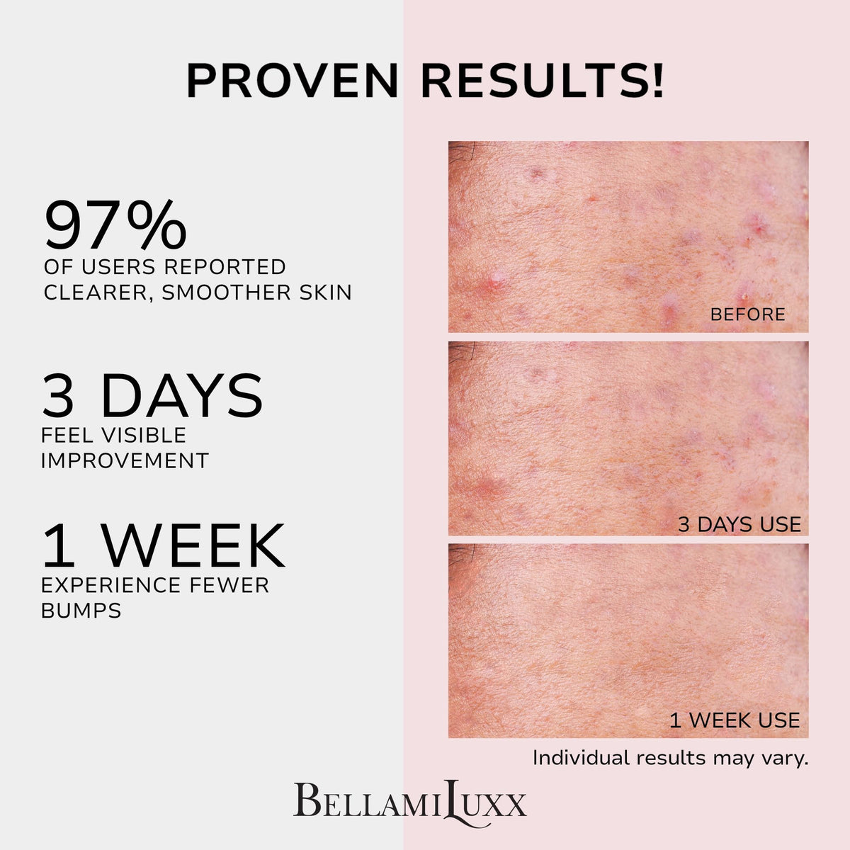 BellamiLuxx butt acne lotion pump close-up for easy application