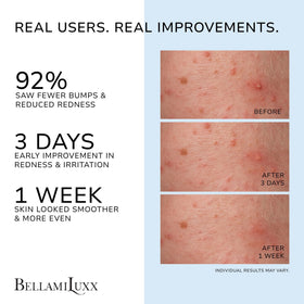 BellamiLuxx Folliculitis Lotion pump-dispense for easy, even daily application.