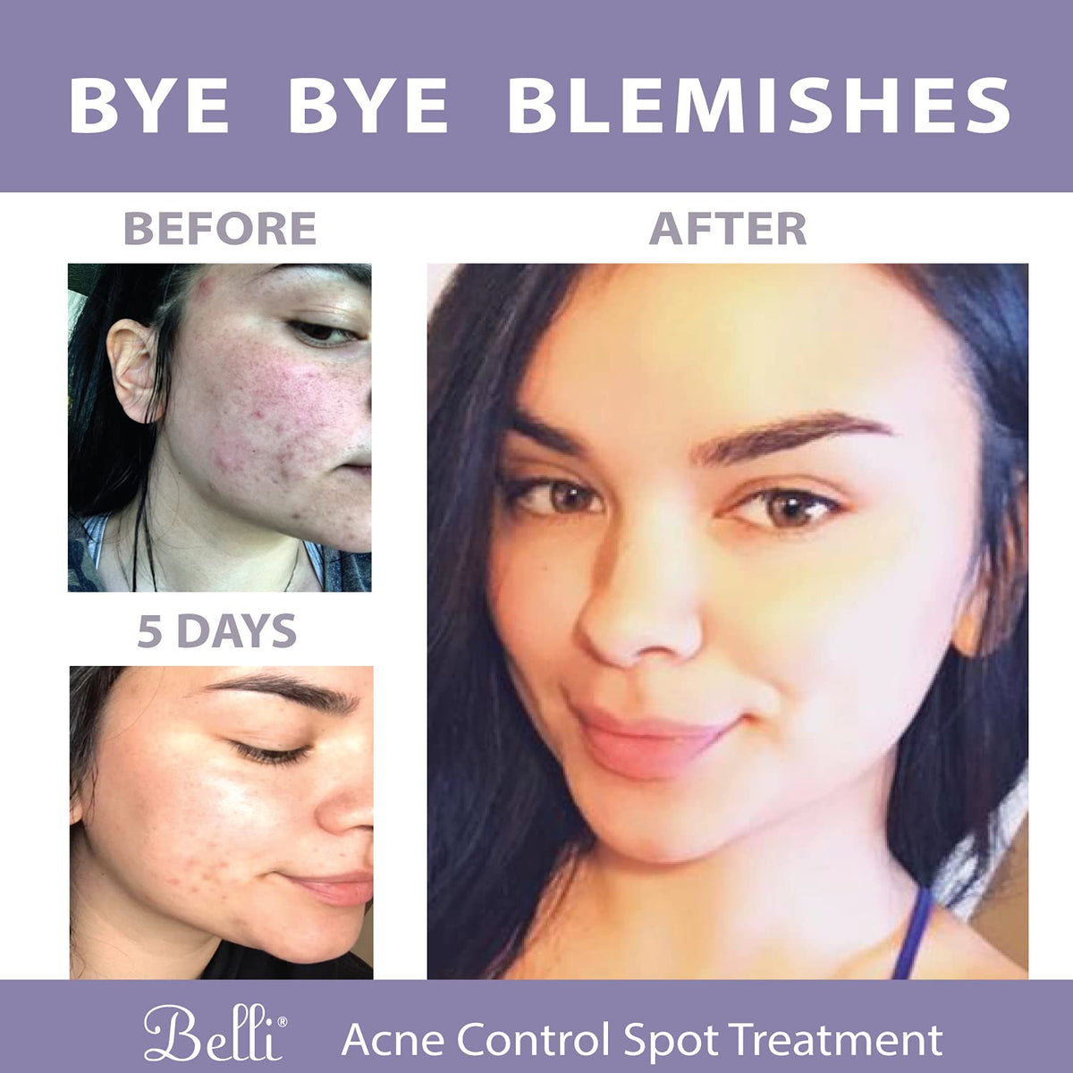 Belli Acne Control Spot Treatment included in regimen with other Belli products
