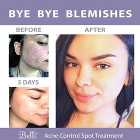 Belli Acne Control Spot Treatment included in regimen with other Belli products