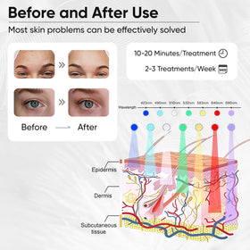 Beuwe full-face coverage mask provides broad treatment area.