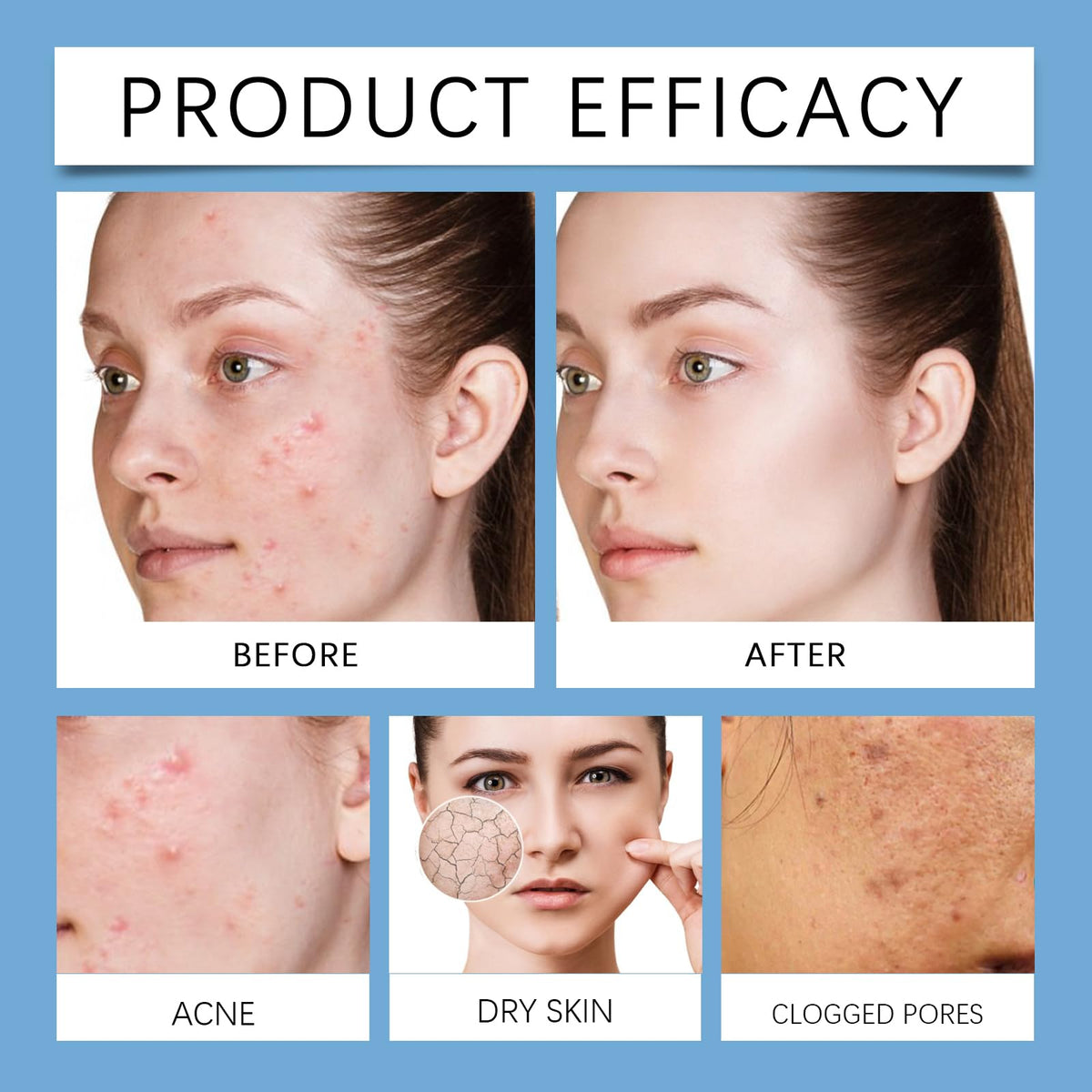 Birunwer Acne Set redness reduction focus for even complexion