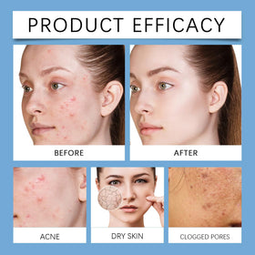 Birunwer Acne Set redness reduction focus for even complexion