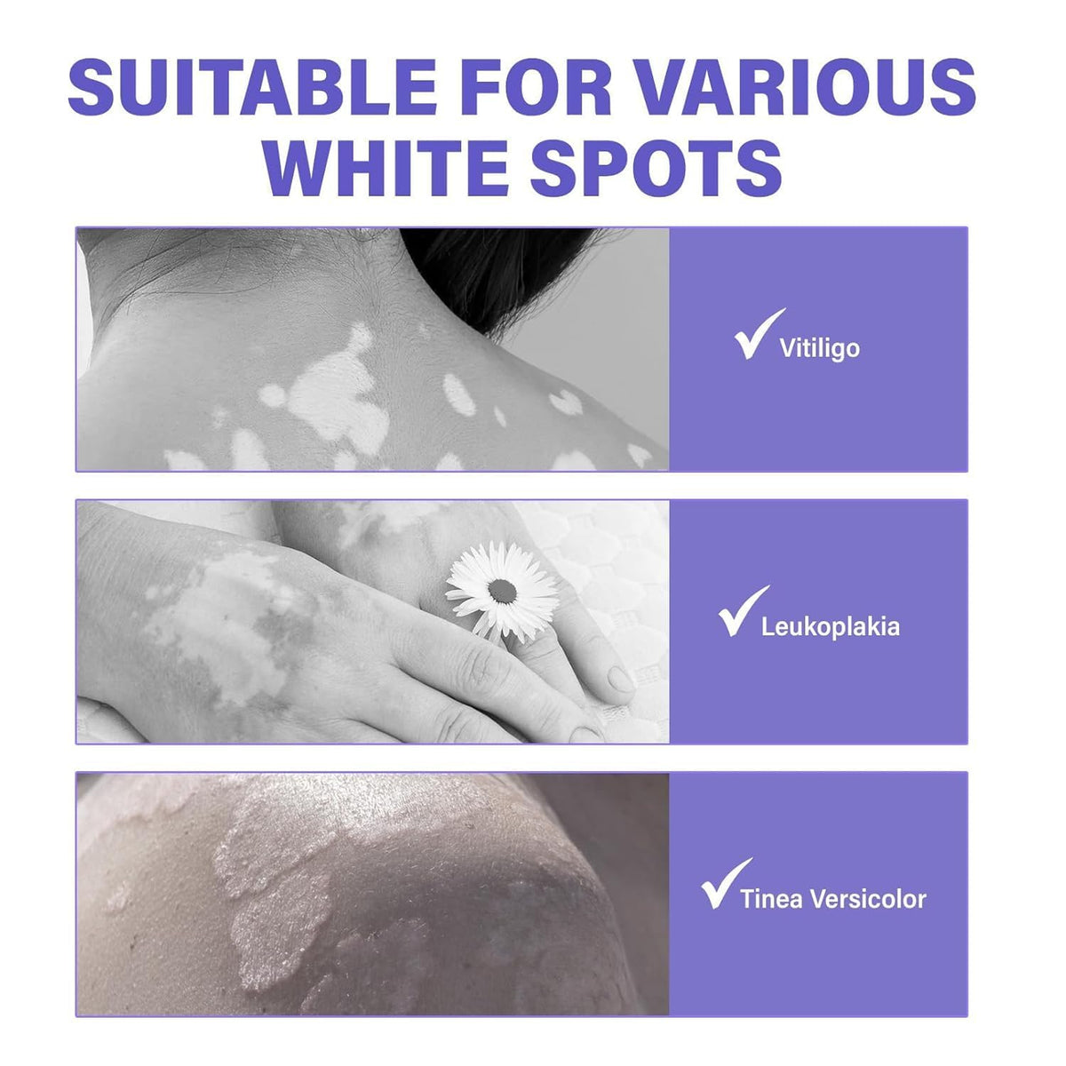 Bizzico Vitiligo Cream 20g label showcases precise dosage and value.
