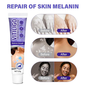 Bizzico Vitiligo Cream texture closeup shows creamy, light feel on the skin.