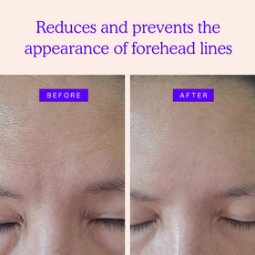 Blumbody forehead patches on skin may visibly reduce fine lines around the brow area.