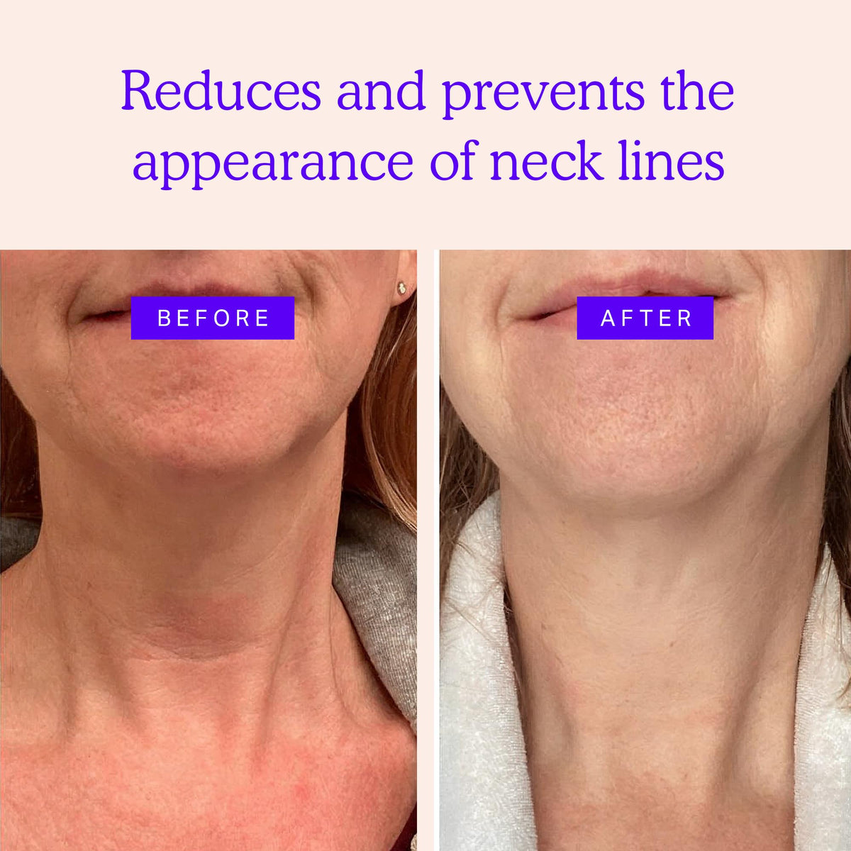 BLUMBODY Neck Patches close-up smooth silicone texture for subtle results