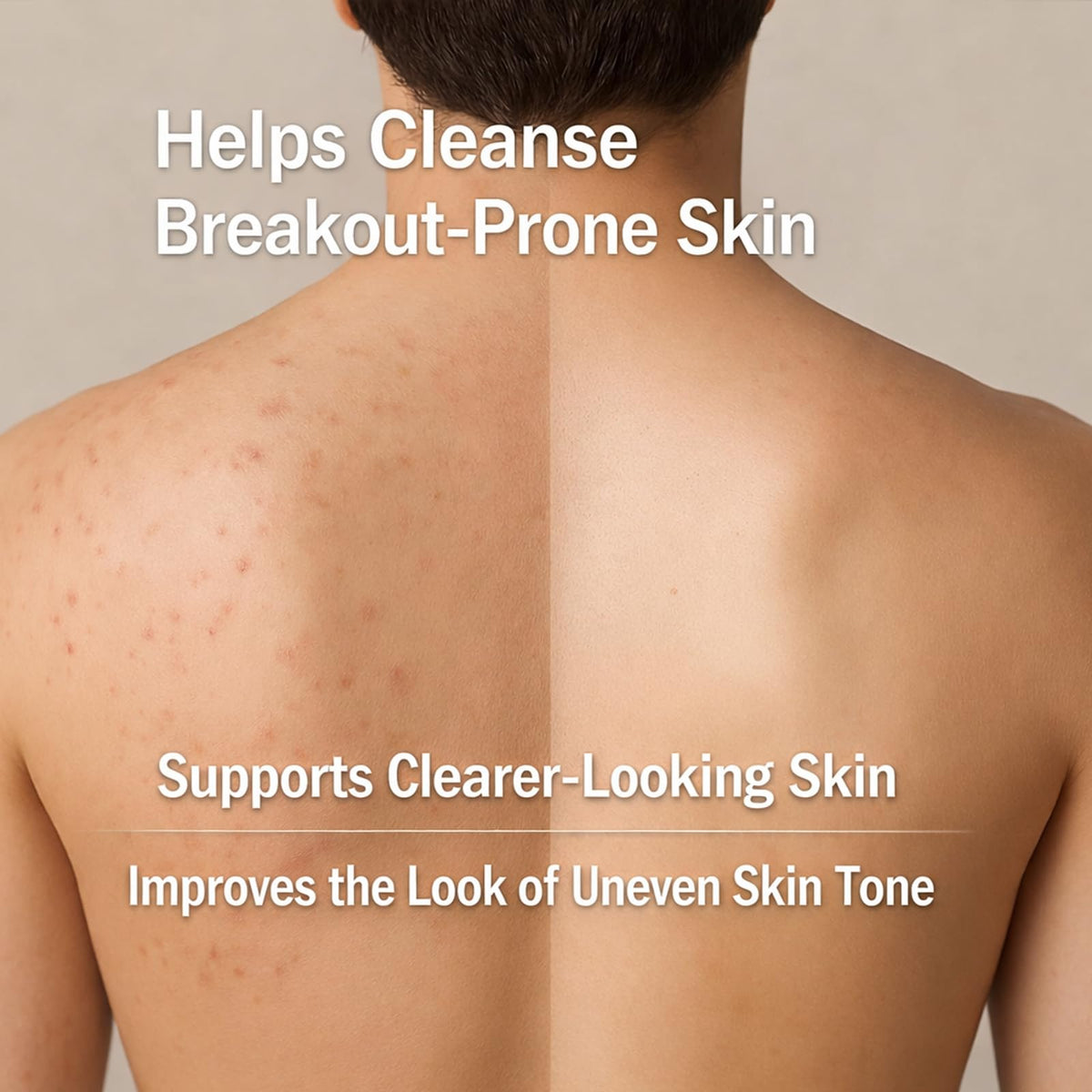 Boaccy Men's Acne Body Wash back skin closeup showing clearer-looking skin over time