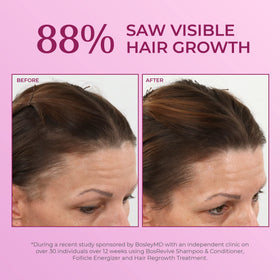 BosleyMD Minoxidil 2% being applied to thinning scalp areas.
