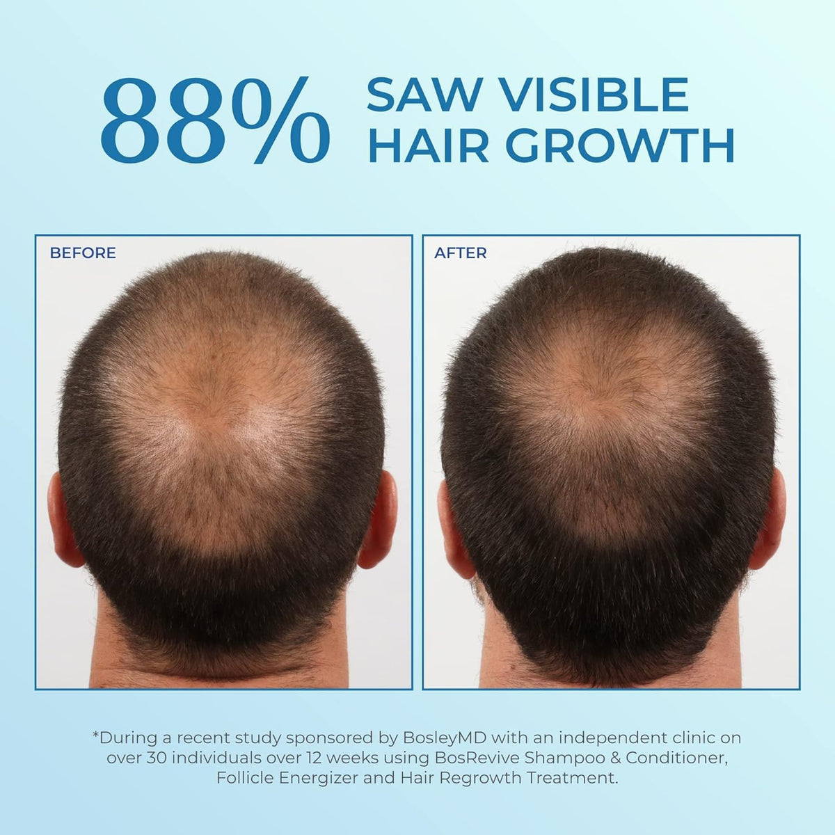 BosleyMD Minoxidil Foam texture closeup as a light, quick-drying mousse