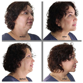 Bring It Up neck lift tape being applied to the neck for a barely-there lift.