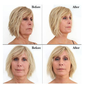 Bring It Up neck lift tape uses hypoallergenic medical-grade adhesive for sensitive skin.