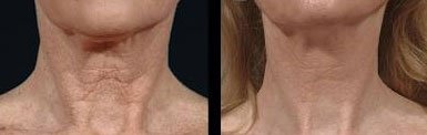 Bring It Up neck lift tape is made in the USA for quality you can trust.
