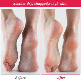CIATBYYJ closed-heel overnight socks help keep dry skin comfortable.