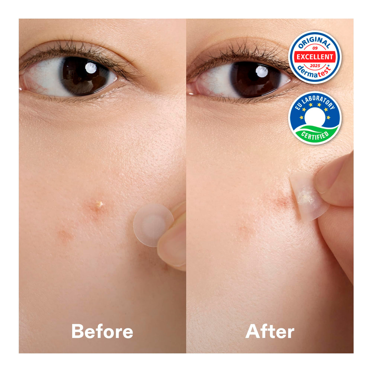 Cordiale Centella patches with hydrocolloid core absorbing impurities effectively.