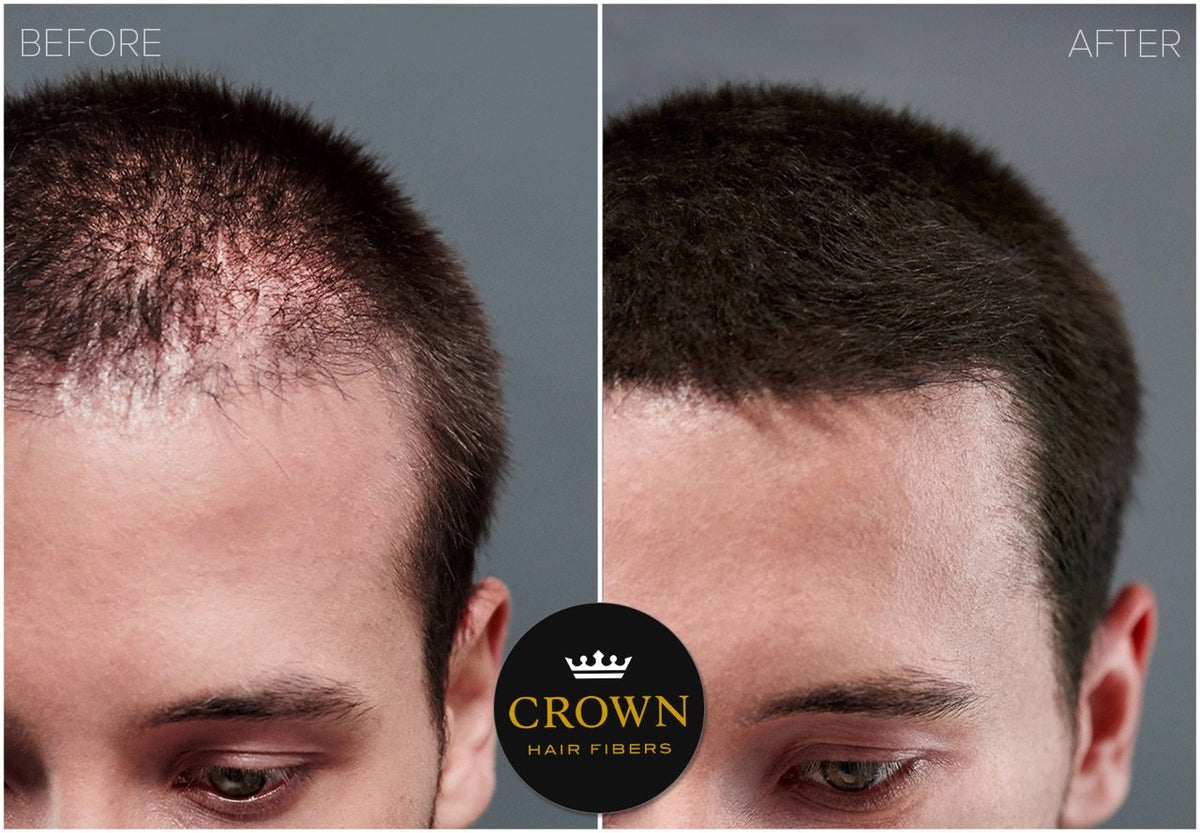 CROWN TWENTY1 before-after close-up reveals subtle thickening on scalp.