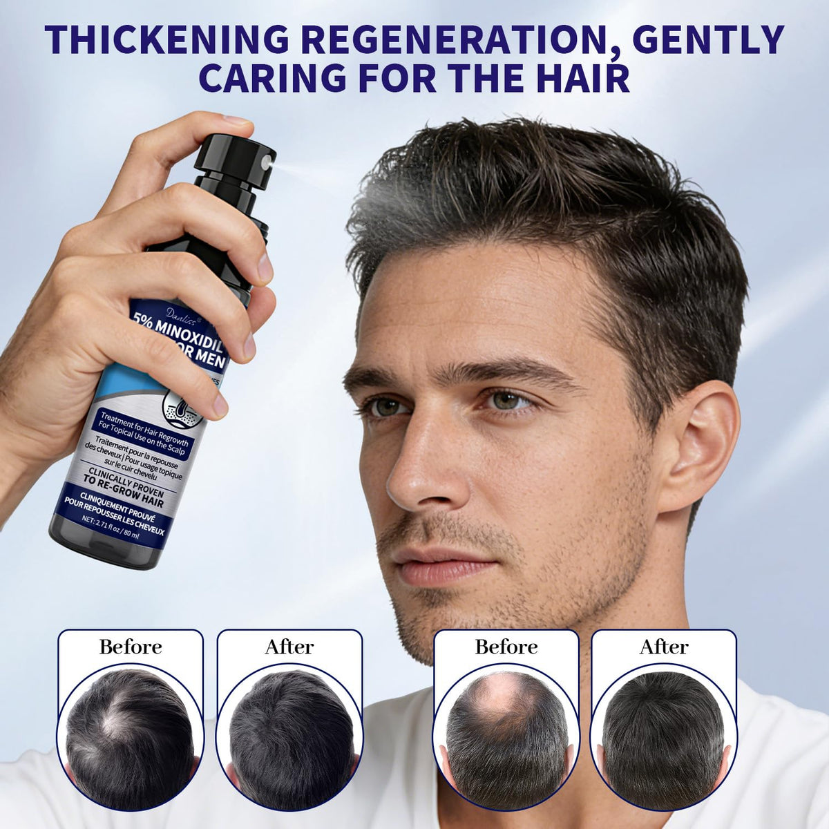 Danliss Minoxidil aids beard growth with focused facial area application