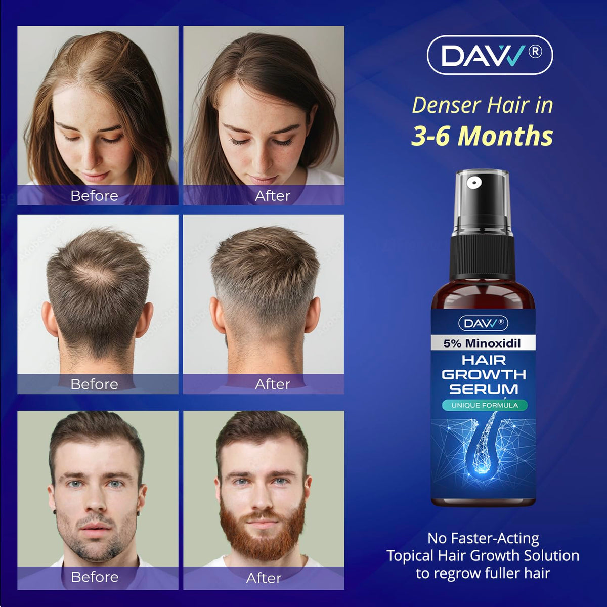 DAVV 5% Minoxidil spray fast absorption into the scalp for quicker results.