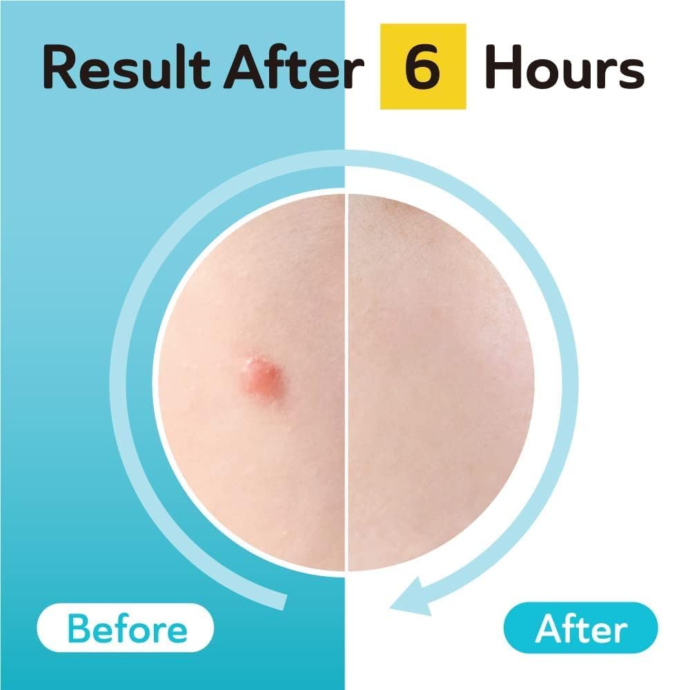 132-count DERMA ANGEL patch pack for ongoing acne care.