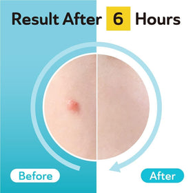 132-count DERMA ANGEL patch pack for ongoing acne care.
