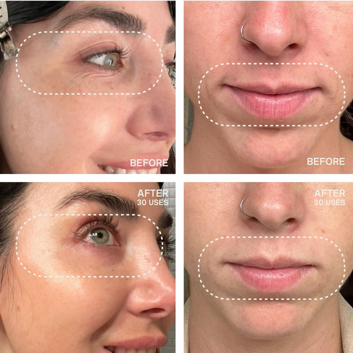 Dermaclara eye patches applied demonstrating smooth, hydrated under-eye area.