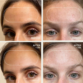 Dermaclara forehead patch used with serums to boost absorption.