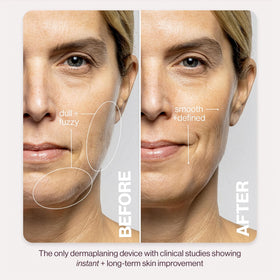 DERMAFLASH LUXE+ microfine edge blades close-up for safe exfoliation