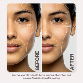 DERMAFLASH LUXE+ safety cage close-up showing protective design