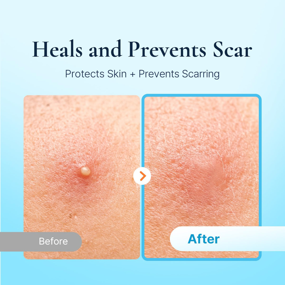 DERMAKR thin hydrocolloid sheet covers blemishes without drawing attention.