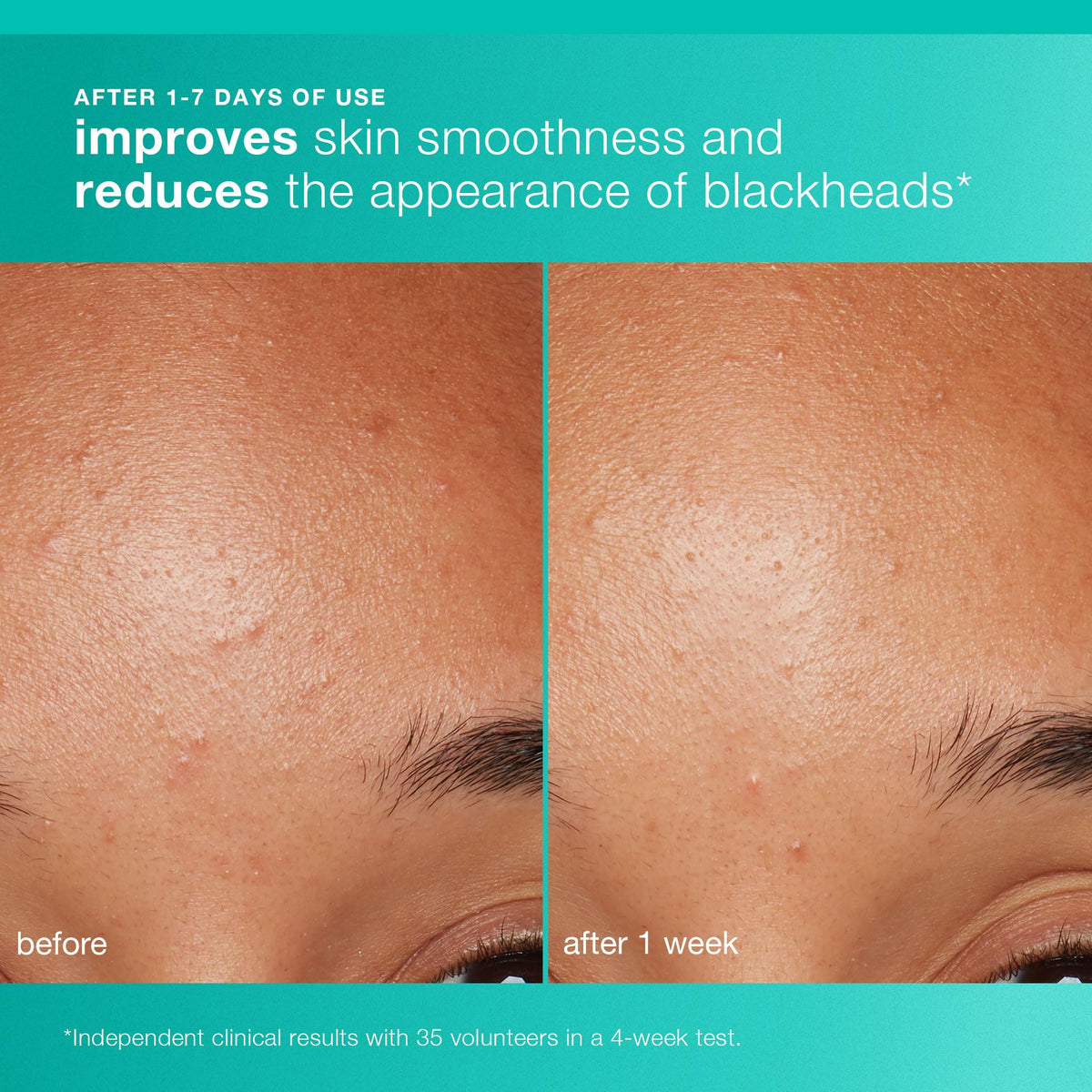 Dermalogica Clearing Skin Wash controls oil and soothes irritation.