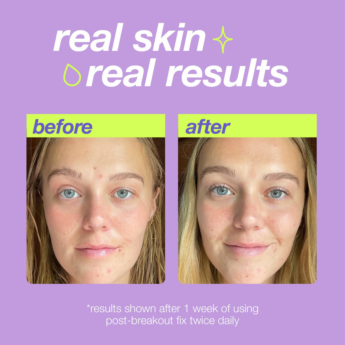 Dermalogica Clear Start Post-Breakout Fix gel-texture swirls on skin to refine texture.