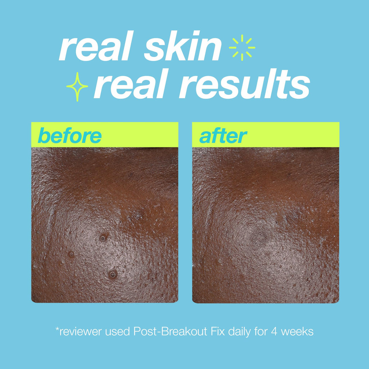 Dermalogica Clear Start Post-Breakout Fix ready for night use with hydrating feel.